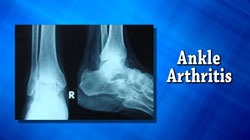 Ankle Arthritis