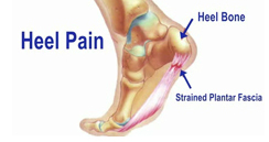 Heel Pain