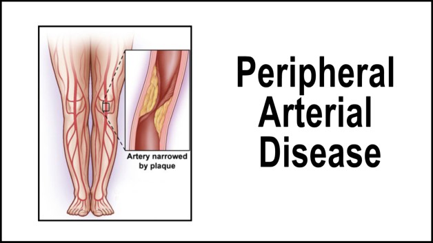 Peripheral Arterial Disease