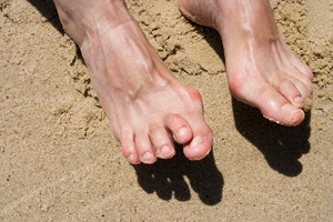 Understanding Hammertoes
