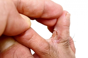 Athlete&#039;s Foot and and Why It Reoccurs