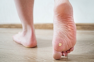 How HPV Causes Plantar Warts