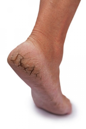 Getting to the Cause of Cracked Heels