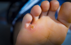 Understanding Seed Corns on the Foot