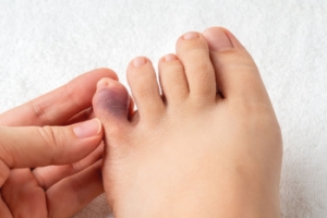 Causes and Symptoms of a Broken Pinky Toe