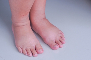 ​​Swollen Ankles