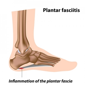 Can Sudden Weight Gain Cause Plantar Fasciitis?