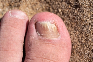Preventing Toenail Fungus