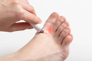 Uncomfortable Athlete&#039;s Foot