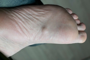 Facts About Plantar Fibroma