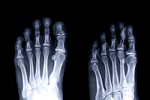 Symptoms and Causes of Metatarsalgia