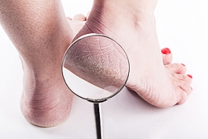 Can Wearing Certain Shoes Contribute to Cracked Heels?