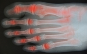 Arthritis: What Causes It &amp; How to Treat It