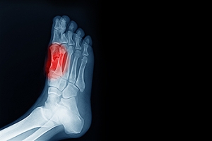 Pain Beneath the Big Toe