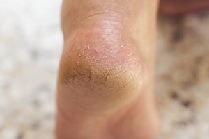 Causes and Treatment of Heel Fissures